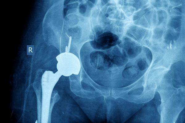 X-ray of the hip prosthesis